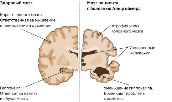 Рисунок здорового мозга и мозга при Альцгеймере