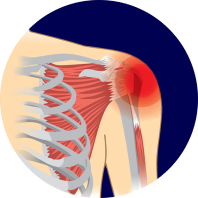 Боли в сухожилиях мышц ротаторной манжеты