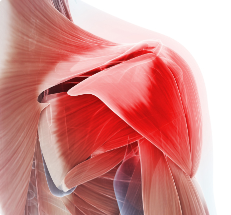 Боль в плече при разрыве ротаторной манжеты
