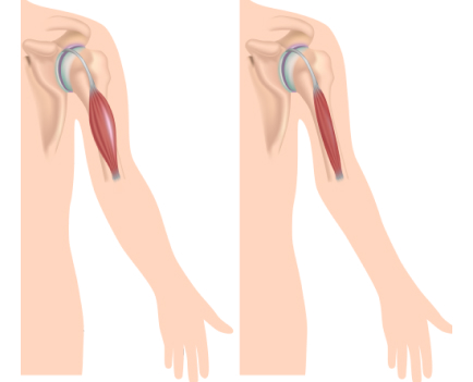 Рисунок плеча с мышечной дистрофией