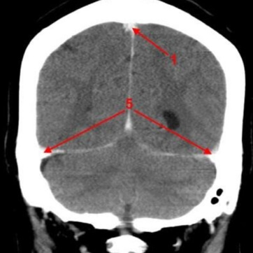 Снимок деформации артерий мозга при боли сосудистого генеза
