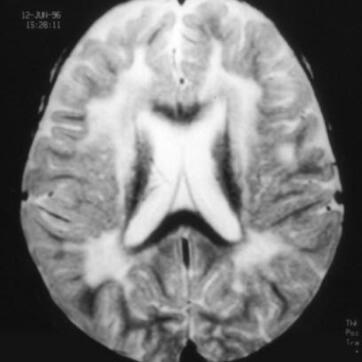 Болезнь Бинсвангера на черно-белом снимке мозга