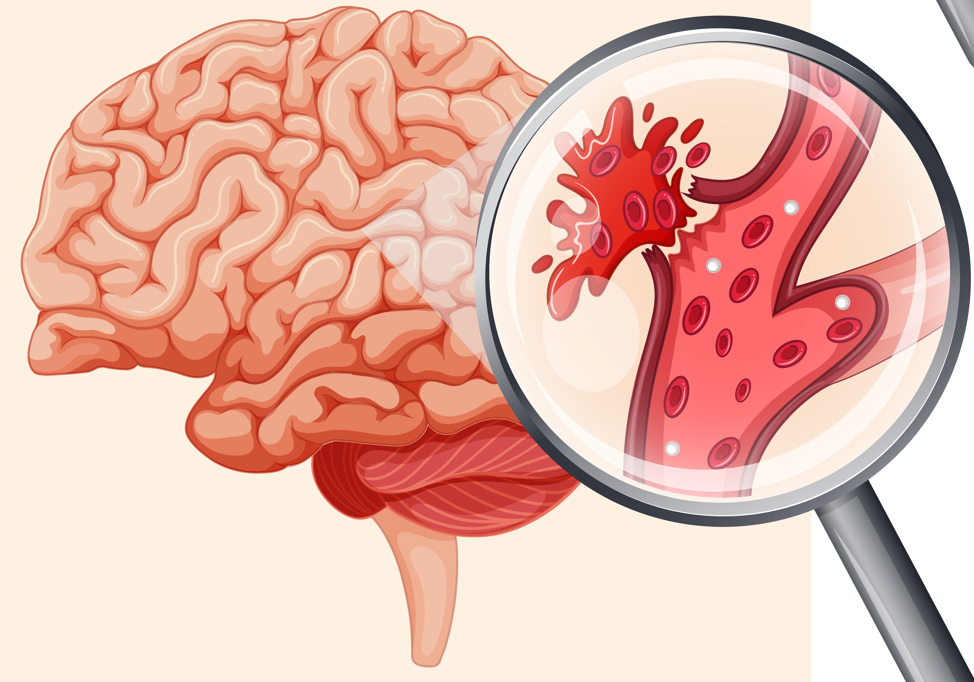 Инсульт картина. Геморрагический инсульт кровоизлияние в мозг. ОНМК геморрагический инсульт. Разрыв сосуда головного мозга геморрагический инсульт. Геморрагический инсульт с кровоизлиянием в головной мозг.