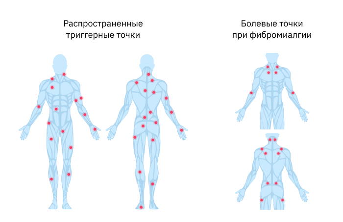 Триггерные точки это простыми словами. Болевые точки. Триггерные точки на теле. Болевые точки на теле. Карта триггерных точек на теле человека.